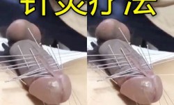 这是什么他妈的疗法针灸鸡巴